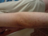 Poštípání štěnicí 3 | Galerie škůdců a škod