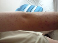 Poštípání štěnicí 2 | Galerie škůdců a škod