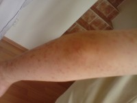 Poštípání štěnicí | Galerie škůdců a škod